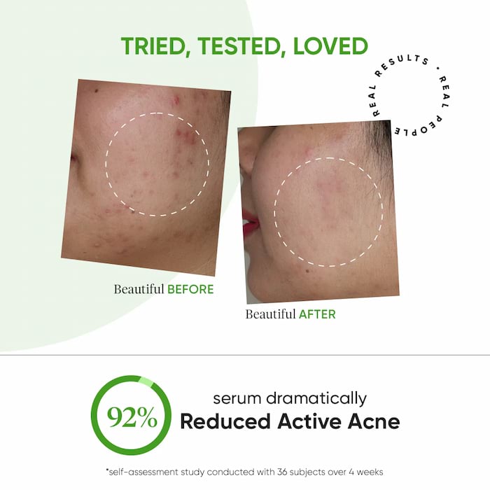 Dot & Key Cica + 2% Salicylic Acid Serum For Acne And Oil Control, 30 ml 3 Dot & Key Cica + 2% Salicylic Acid Serum For Acne And Oil Control, 30 ml